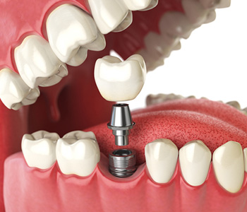 Single Tooth Implant in Pasadena CA area