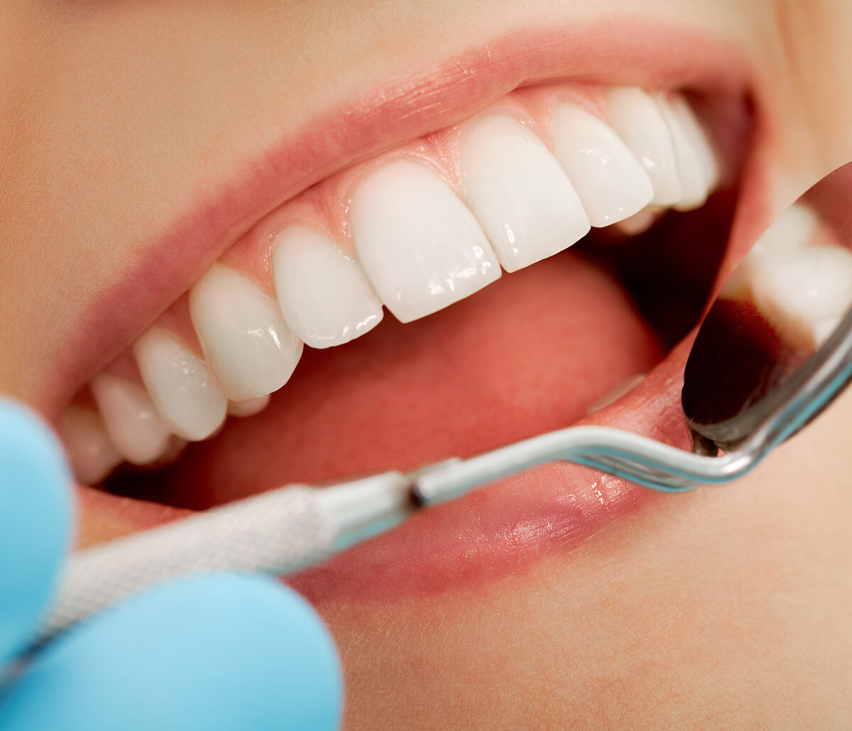 Teeth Whitening Dentist at Pasadena Prosthodontics in Pasadena CA Area